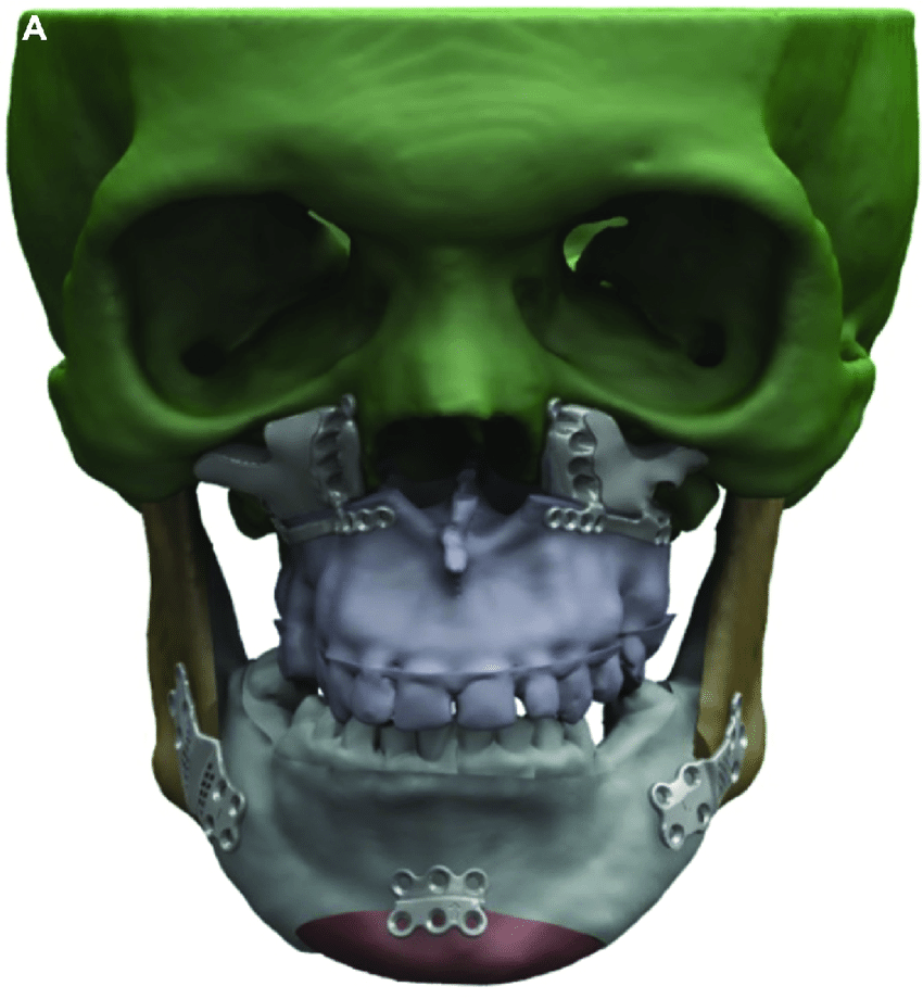 Final-virtual-surgical-planning-with-custom-made-miniplates-and-polyethylene-graft